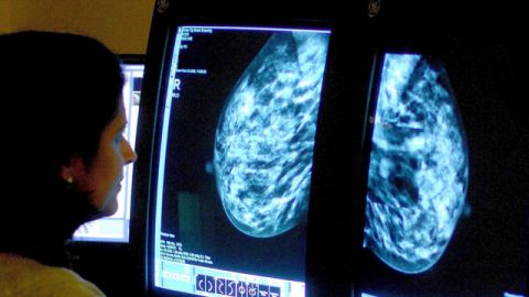 Radiographer reads a mammogram. (Rui Vieira/PA Wire)