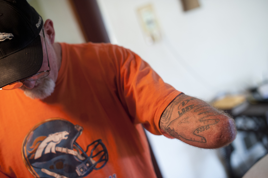 Dennis Whedbee got a tattoo of his lost hand after workers’ comp offered him a prosthesis with a hook instead of the one with a hand his doctor recommended. “I got tired of people staring at it,